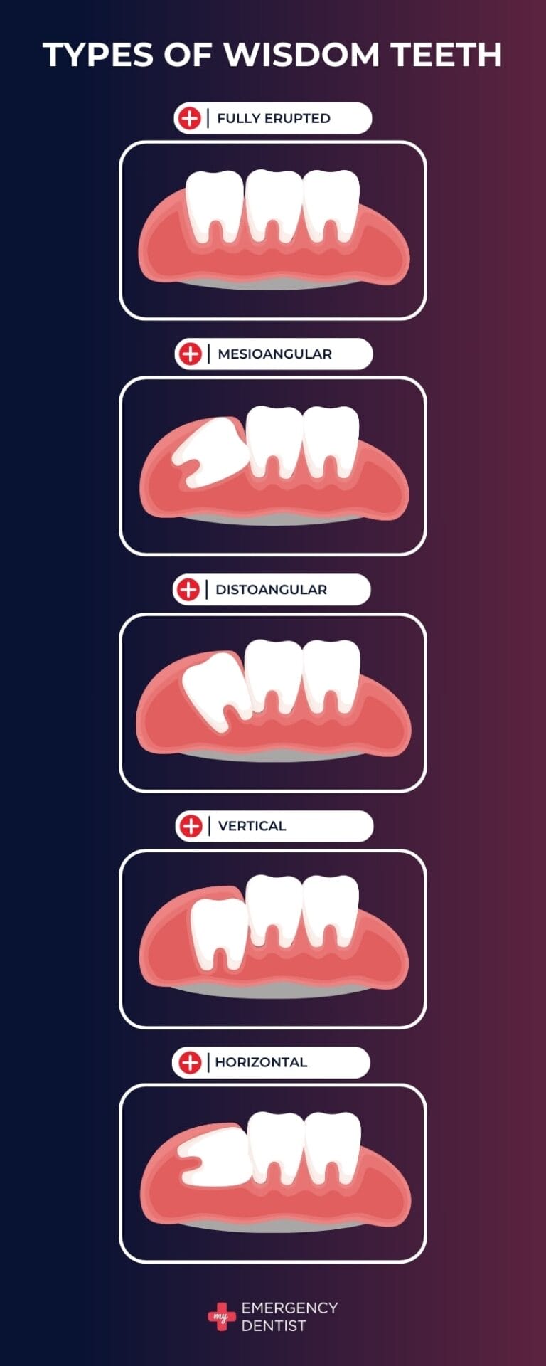 Types of Emergency Wisdom Tooth Removal cases in Brisbane