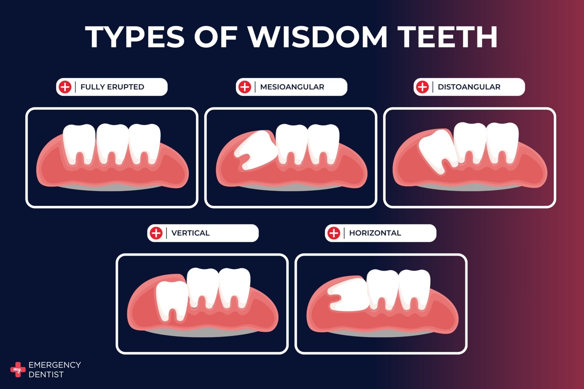 Types of Wisdom Teeth for Emergency Wisdom Tooth Removal in Brisbane