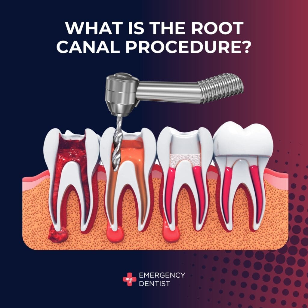 Root Canal Procedure in Brisbane