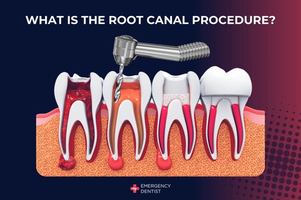 What Is the Root Canal Procedure